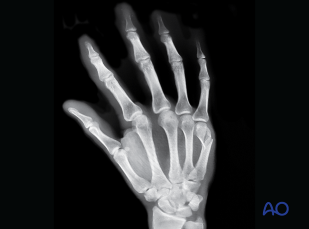 Oblique x-ray of the hand showing an extraarticular fracture of the distal end segment