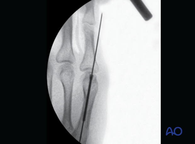 Intraoperative image showing the guide wire and screw for intramedullary screw fixation of the 5th metacarpal fracture