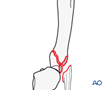 Articular fracture of the 5th metacarpal base