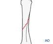 Simple oblique fracture of a metacarpal shaft