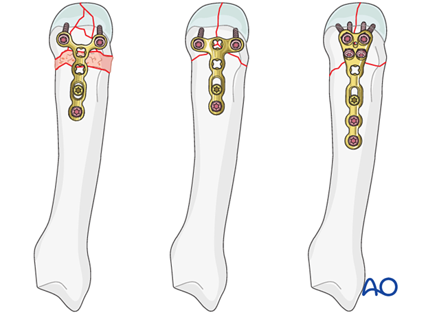 Plating of a complete articular fracture of the metacarpal head