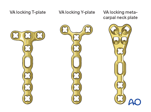 Plate selection for fixation of complete articular fractures of the metacarpal head