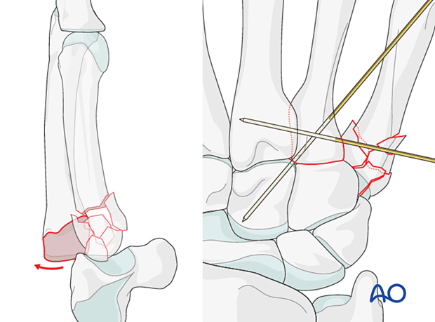 Dislocation of the 4th metacarpal associated to a complete articular fracture of the 5th metacarpal base