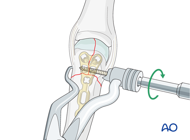 Reduction and fixation of the articular block in a simple T- and Y-shaped fracture of the 5th metacarpal head with a lag screw