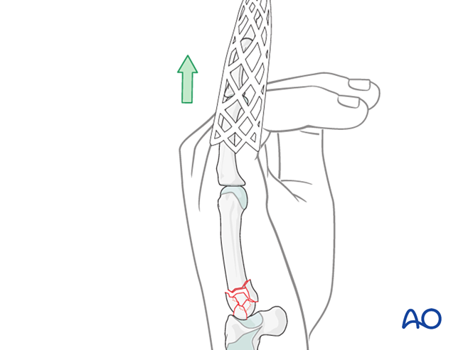 Arthrodiastasis with a joint-bridging plate for Complete articular ...