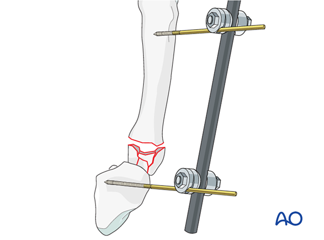 Arthrodiastasis with a joint-bridging plate for Complete articular ...