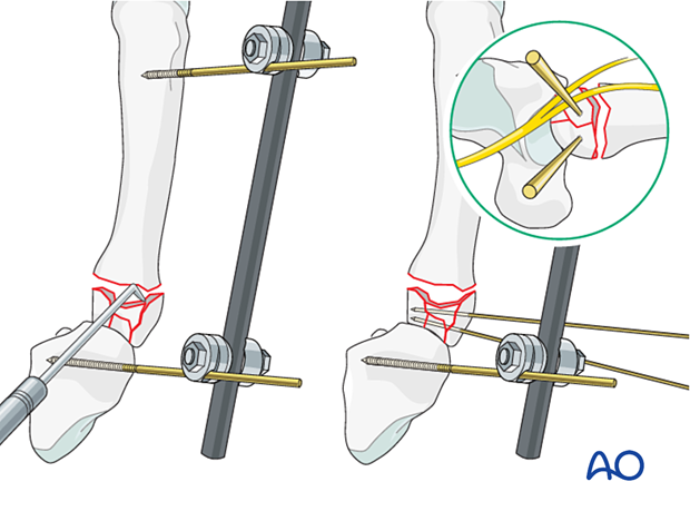 Reduction of the articular fragments in a complete articular fracture of the 5th metacarpal base