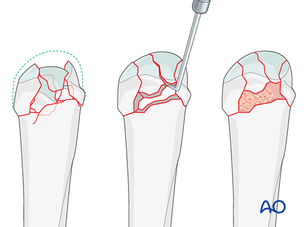 Reconstruction of an impacted complete articular fracture of a metacarpal head 