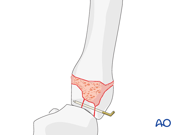 Stabilization of the articular fragments in a complete articular fracture of the 5th metacarpal base with a K-wire and added cancellous autograft