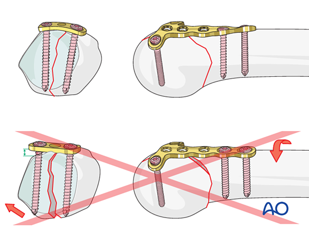 Contouring the plate exactly to the bone surface to achieve compression across the whole fracture plane