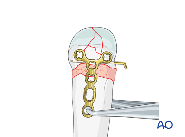 Application of a T-plate for stabilization of a complete articular fracture of a metacarpal head