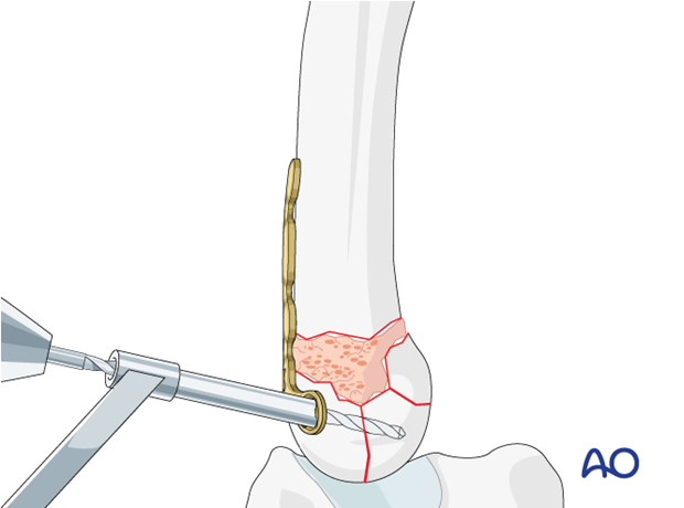 T-plate fixation of a complete articular fracture of a metacarpal base - Insertion of a screw through the plate into the articular block