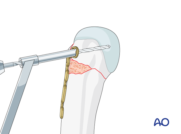 T-plate fixation of a complete articular fracture of a metacarpal head - Insertion of a screw through the plate into the articular block