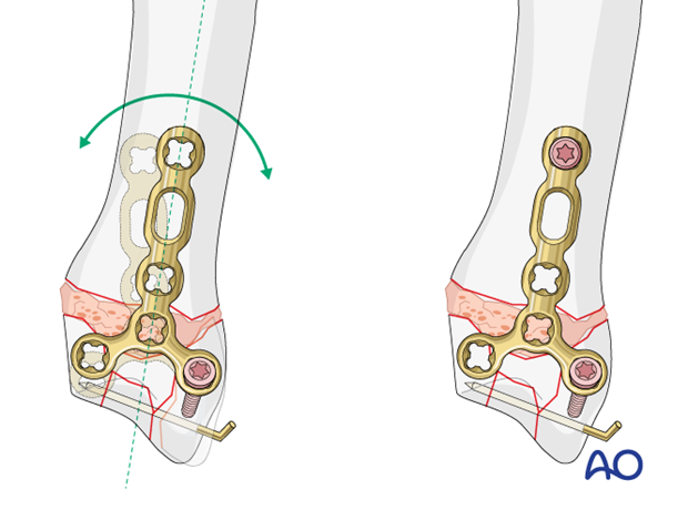 T-plate fixation of a complete articular fracture of a metacarpal base – Aligning the plate and insertion of a screw through the plate into the shaft