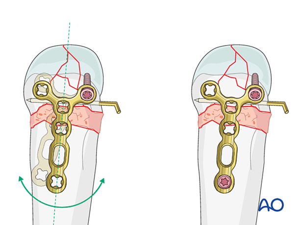 T-plate fixation of a complete articular fracture of a metacarpal head – Aligning the plate and insertion of a screw through the plate into the shaft