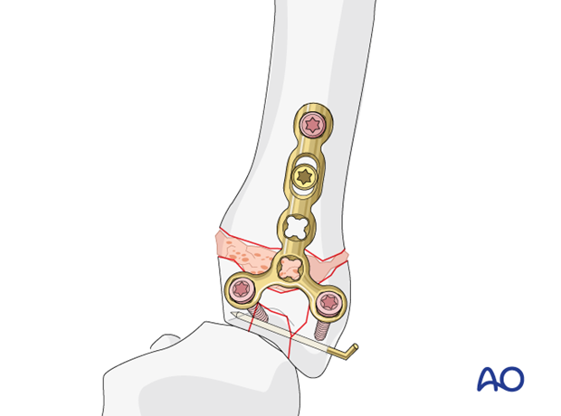 T-plate fixation of a multifragmentary complete articular fracture of a metacarpal base