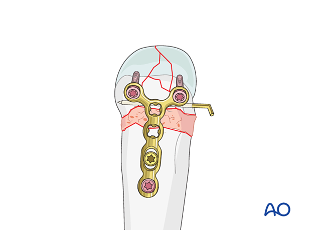 T-plate fixation of a multifragmentary complete articular fracture of a metacarpal head