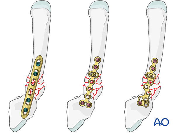 Arthrodiastasis of a multifragmentary articular fracture of the 5th metacarpal base with a joint-bridging plate