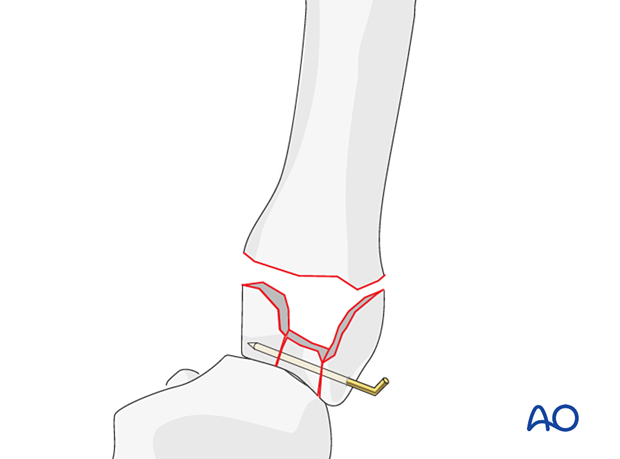 Stabilization of the articular fragments in a complete articular fracture of the 5th metacarpal base with a K-wire