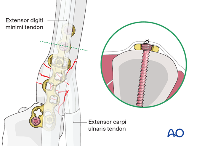 Arthrodiastasis with a joint-bridging plate for Complete articular ...