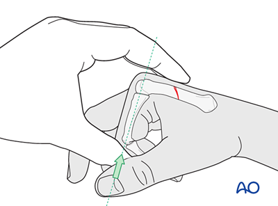 Closed reduction - Splinting for Simple oblique fracture of the diaphysis