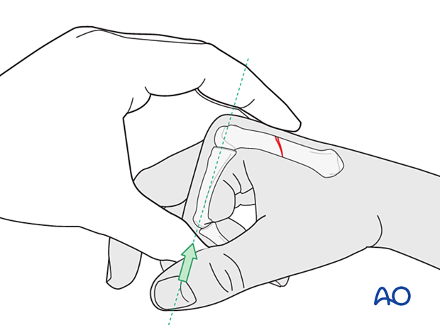 Jahss maneuver to reduce a metacarpal fracture