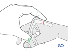 Manual reduction of a transverse fracture of the metacarpal diaphysis