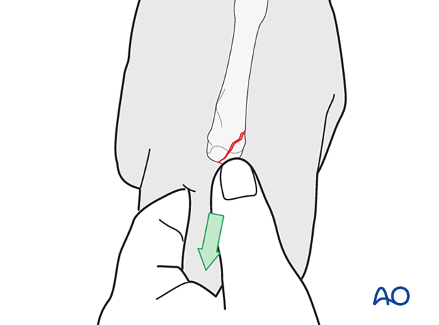 Manual reduction of an articular metacarpal fracture