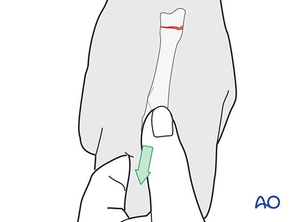 Manual reduction of a metacarpal fracture