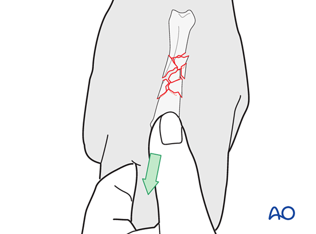 Manual reduction of a metacarpal fracture