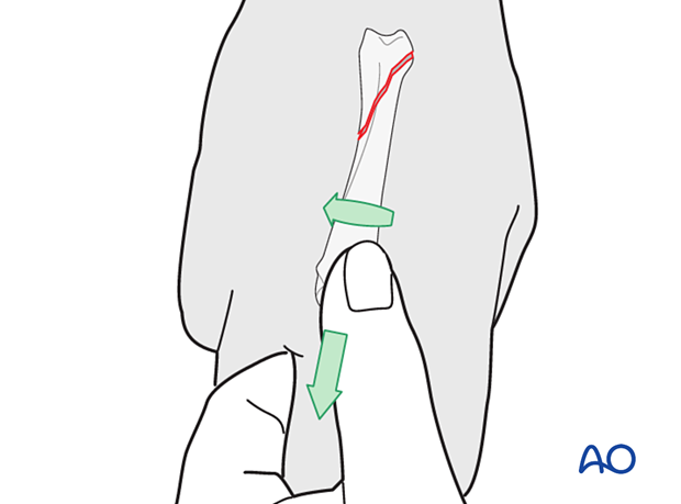 Manual reduction of a spiral oblique fracture by a combination of longitudinal traction on the finger and derotation