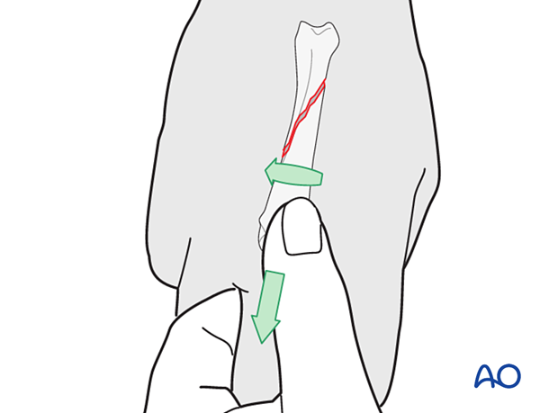 Manual reduction of a spiral oblique fracture by a combination of longitudinal traction on the finger and derotation