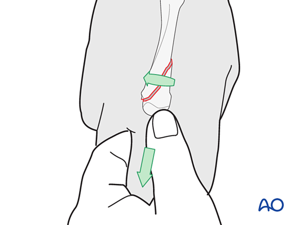 Manual reduction of a spiral oblique fracture by a combination of longitudinal traction on the finger and derotation