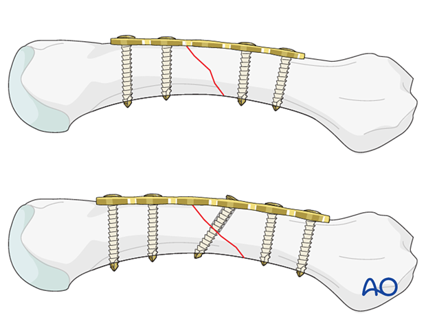 Compression plating of an oblique metacarpal shaft fracture