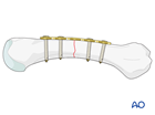 Compression plating of a transverse fracture of the metacarpal diaphysis