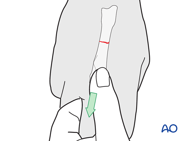 Closed reduction by manual traction of a metacarpal shaft fracture