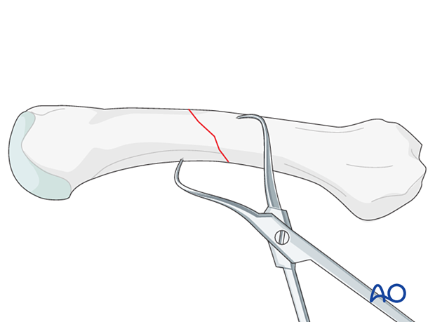 Application of pointed reduction forceps to reduce and hold a metacarpal shaft fracture