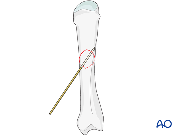 K-wire inserted to provisionally hold reduction of a metacarpal shaft fracture