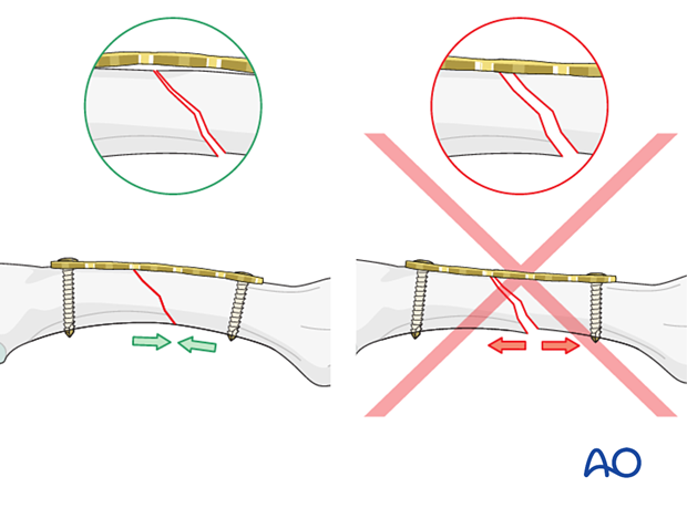 Overbending the plate relative to the bone surface results in compression across the whole fracture plane