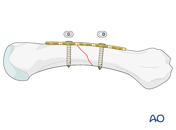 Application of a compression plate to an oblique metacarpal fracture