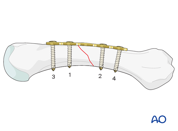 Order of screw insertion for compression plating of an oblique metacarpal shaft fracture