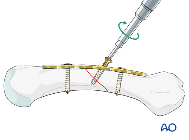 Insertion of a lag screw through a plate for compression of an oblique metacarpal shaft fracture 