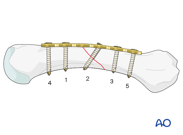 Order of screw insrertion for compression plating with lag screw through the plate of an oblique metacarpal shaft fracture 