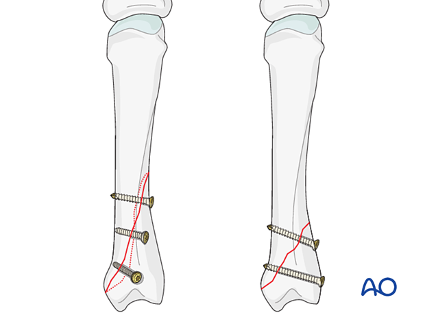 Lag-screw fixation with two or more screws of long oblique and spiral metacarpal fracture