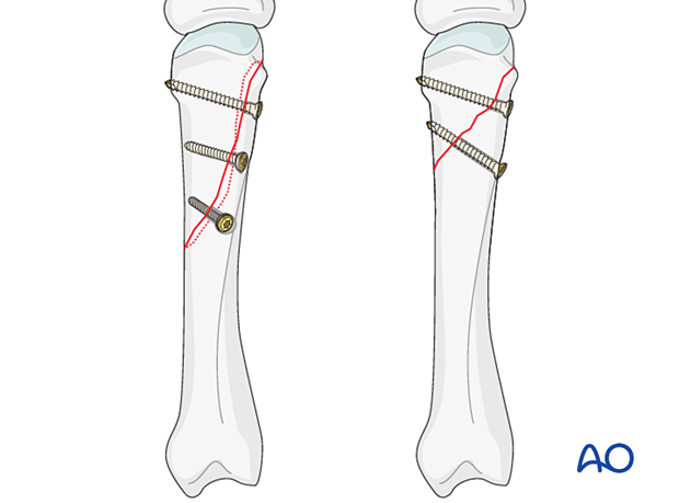 Lag-screw fixation with two or more screws of long oblique and spiral metacarpal fracture