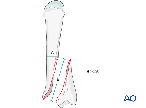 Model to determine screw placement of interfragmentary screws for long oblique and spiral metacarpal fracture