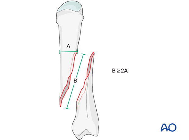 Model to determine screw placement of interfragmentary screws for long oblique and spiral metacarpal fracture