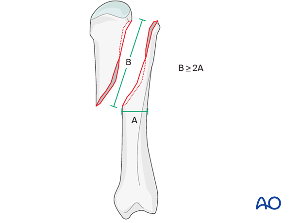 Model to determine screw placement of interfragmentary screws for long oblique and spiral metacarpal fracture