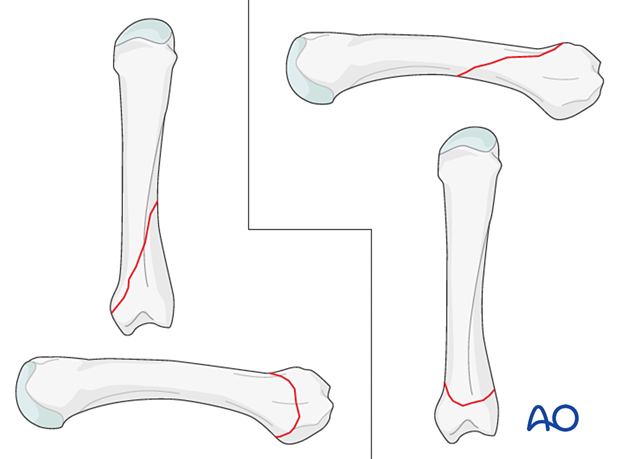 AP and lateral views of oblique metacarpal fractures