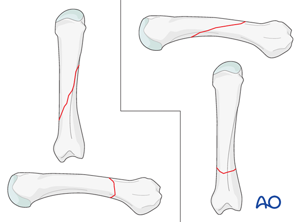 AP and lateral views of oblique metacarpal fractures